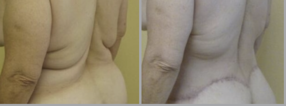 Lower Body Lift in Ventura, CA